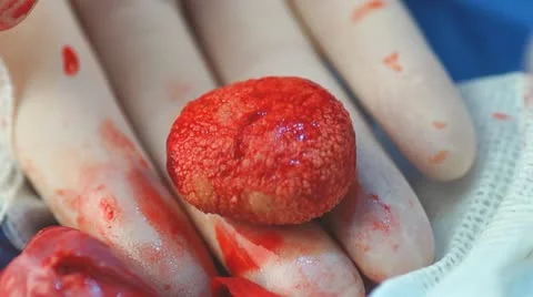 Bladder Surgery Stock Footage 22040351