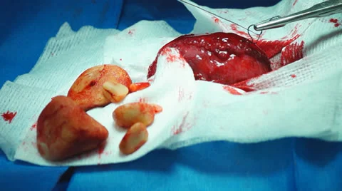 Bladder Veterinary Surgery  Stock Footage 23879926