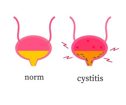 Bladder on a white background. Cystitis. Vector. Stock Illustration