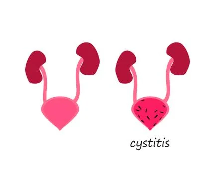 Bladder on a white background. Cystitis. Vector. Stock Illustration