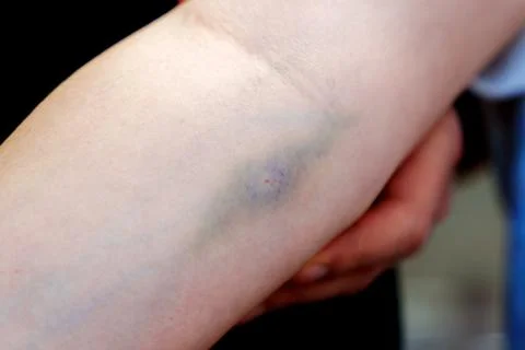 Bleeding, after blood drawing testing for annually physical health check up t Stock Photos