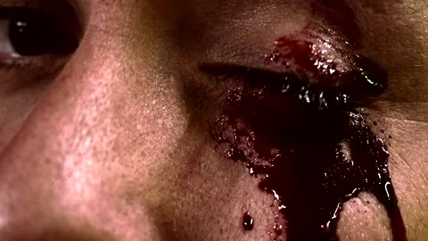 Bleeding eye close up Stock Footage 152545313