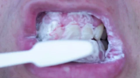 Bleeding gums in a man. Gingivitis or periodontitis Stock-Footage 78813283
