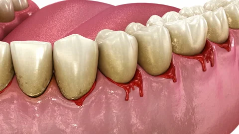 Bleeding gums or Periodontal - pathological inflammatory condition Stock Footage 282026314