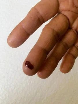 A bleeding hand Stock Photos