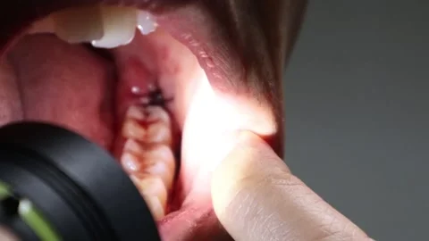 Bleeding mouth immediately after wisdom tooth extraction Stock Footage 325687571