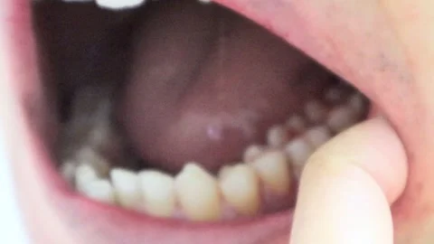 Bleeding mouth immediately after wisdom tooth extraction Stock Footage 325687633
