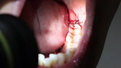 Bleeding mouth immediately after wisdom tooth extraction Stock Footage 325687645