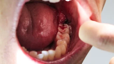Bleeding mouth immediately after wisdom tooth extraction Stock Footage 325687880