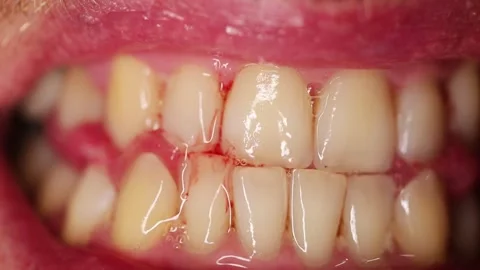 Bleeding from a sore gum at a dentist's appointment, dentist 스톡 동영상 271204009