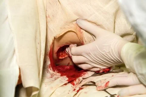 Bleeding stop Stock Photos