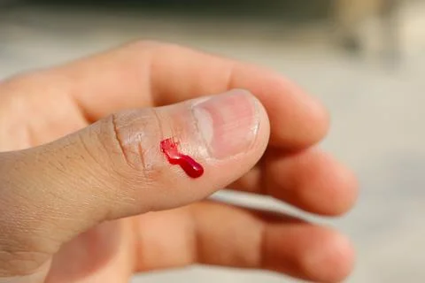 Bleeding from a thumb of a young boy Foto stock