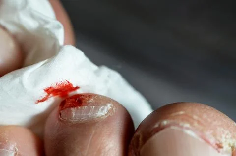 Bleeding on the tip of the second toe of the left foot, insult of the foot .. Stock Photos