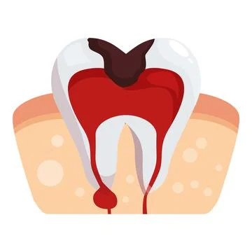 Bleeding tooth with caries showing gingivitis and periodontitis symptoms Stock Illustration