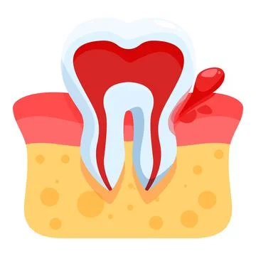 Bleeding tooth showing gingivitis and periodontitis symptoms Illustrazione stock