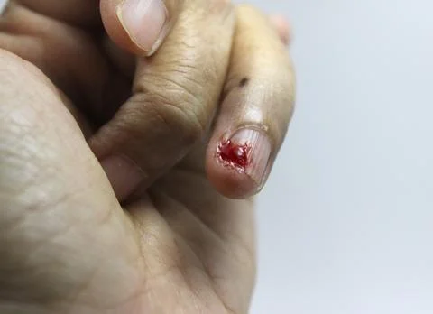 Bleeding wound on finger at left hand with white background, bleeding on li.. Stock Photos