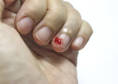 Bleeding wound on finger at left hand with white background, bleeding on li.. Stock Photos