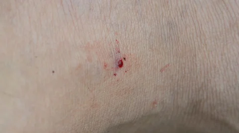 Bleeding from the wound. HD Video stock 41586228