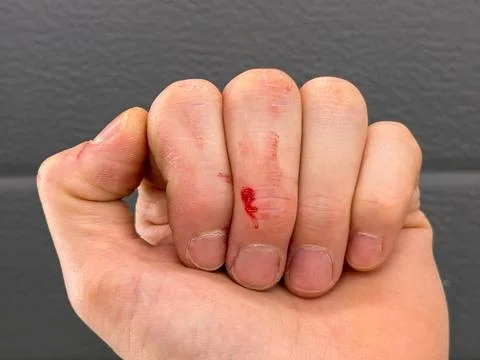 Bleeding wound on the middle finger of the left hand. Stock Photos