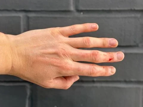 Bleeding wound on the middle finger of the left hand. Stock Photos