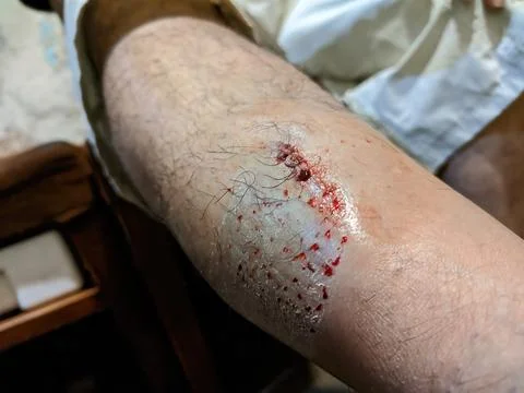 Bleeding wounds on leg Stock Photos