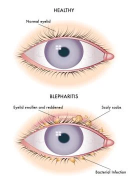 Blepharitis Illustrazione stock