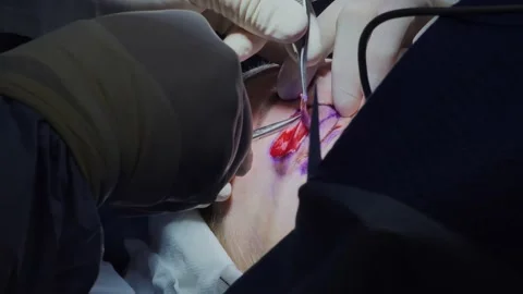 Blepharoplasty, plastic surgery operation for correcting defects, deformities Stock Footage 204741270