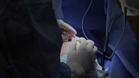 Blepharoplasty, plastic surgery operation for correcting defects, deformities Vídeos de archivo 204741324