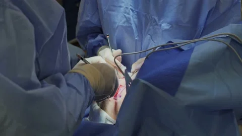 Blepharoplasty, plastic surgery operation for correcting defects, deformities 스톡 동영상 204741427