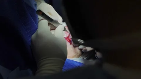 Blepharoplasty, plastic surgery operation for correcting defects, deformities Vidéo 204742009