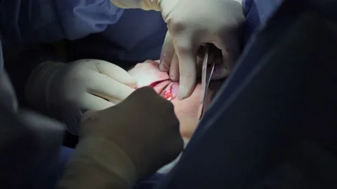 Blepharoplasty, plastic surgery operation for correcting defects, deformities Vidéo 204742657