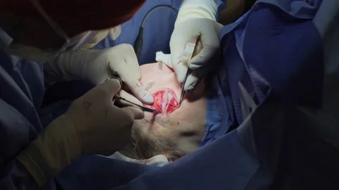 Blepharoplasty, plastic surgery operation for correcting defects, deformities Vídeos de archivo 204742981