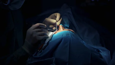 Blepharoplasty. Surgeons' hands in gloves making plastic surgery on female Video stock 144489537