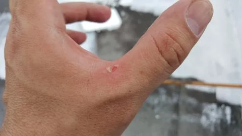Blister in the hand Stock Photos