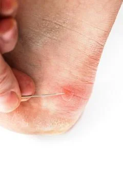 Blister on heel gets pricked with needle to burst it on white background, close Stockfoto's