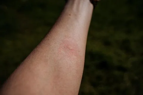 A blister mark from a midge bite on the human body, a red spot from a mosquit Foto stock