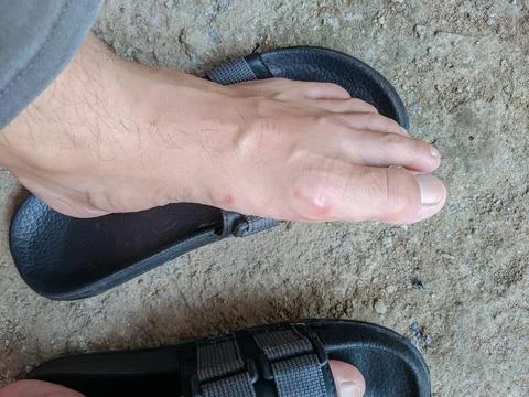 Blistered feet Stock Photos