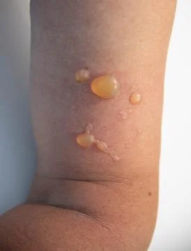 Blisters from a burn on a womans hand. Close-up burn. Thermal burn caused by Stock Photos