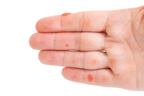 The blisters on the palm from overwork. Stock Photos