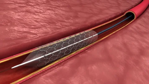 Blocked artery with stent 库存影片 83043765