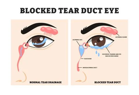 Blocked tear duct vs normal tear drainage, educational medical poster desig.. Stock Illustration