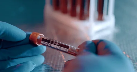 Blood Analysis. Test Tubes. Coronavirus Covid 19 Infected Blood Sample In Tube Stock Footage 127087772