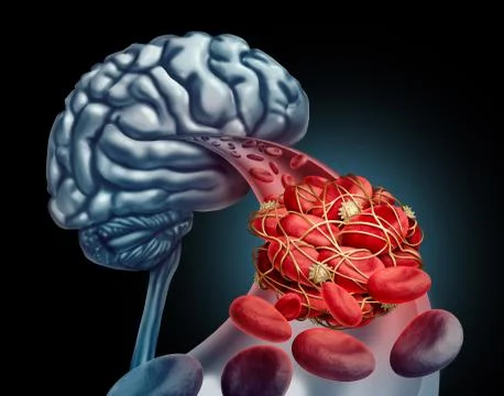 Blood Clot Brain Stock Illustration
