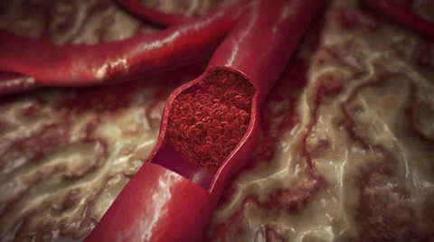 Blood Clot Stock Footage 27811854