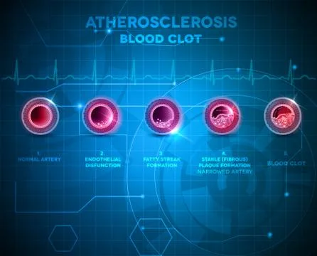 Blood clot Stock Illustration