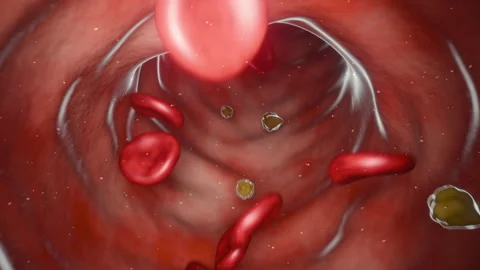 Blood Flow With Cholesterol Particles 動画素材 316619989