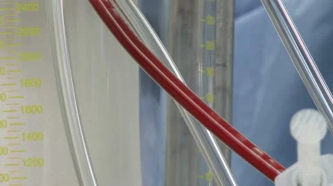 Blood flows through bypass tubes (2 of 2) Video stock 10687347
