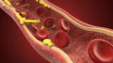 Blood flows through yellowish cholesterol plaques begin forming along the a.. Stock Footage 322184341
