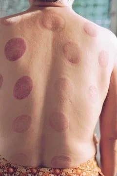 Blood patch mark on back after chinese cupping massage treatment therapy Fotos de archivo