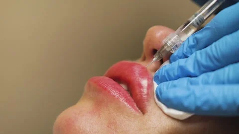 Blood plasma injection into lips. Macro, close up shot of syringe needle. Stock Footage 220539726